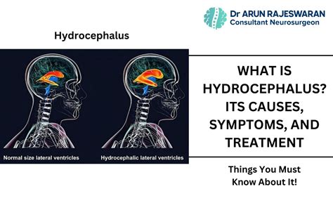 What is Hydrocephalus? Its Causes, Symptoms, And Treatment ...