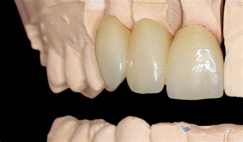 Products NatZRal Plus Super Translucent Zirconia Iverson Dental Labs