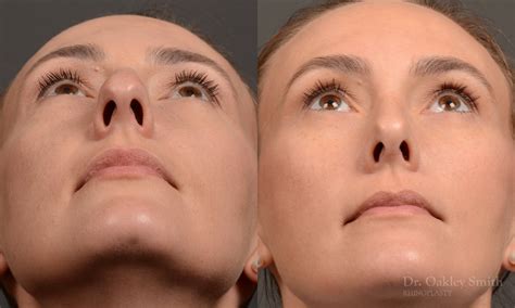 453f Rhinoplasty Dr Oakley Smith Toronto Top Surgeon Nose Job