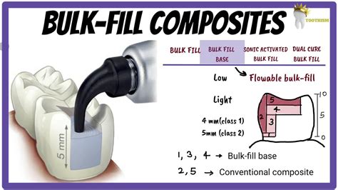 Understanding Bulk Fill Composites Part 2 PankeyGram