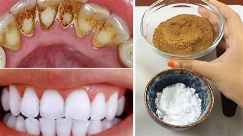 Teeth Whitening At Home In 2 Minutes How To Whiten Your Yellow Teeth Naturally 100