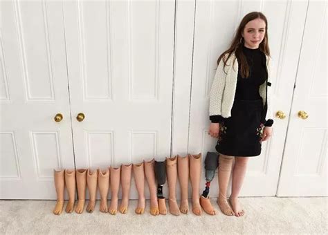 Scottish Teen Who Had Limb Removed When She Was Five Needs New Prosthetic Leg Every Six Months