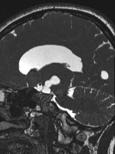 Arachnoid Cyst Interpeduncular Radiopaedia 74496 85399 Sagittal T2 Nc Commons