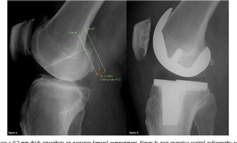 Figure 1 From Large Osteophyte Removal From The Posterior Femoral Condyle Significantly Improves