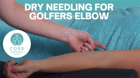 Dry Needling For Golfers Elbow Medial Epicondylitis Youtube