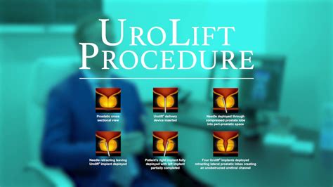 UroLift procedure - YouTube