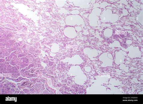 Photomicrograph Of Interstitial Pneumonia Showing Inflammation And