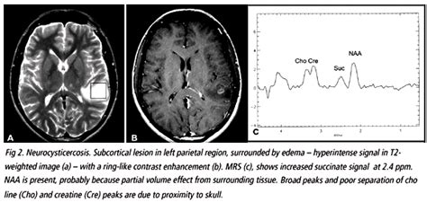 Scielo Brasil The Pattern Of Proton Magnetic Resonance Spectroscopy