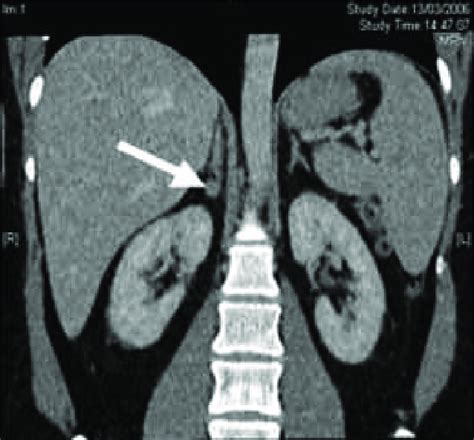 Conn's adenoma in the adrenal gland. MRI scan of patients with high ...