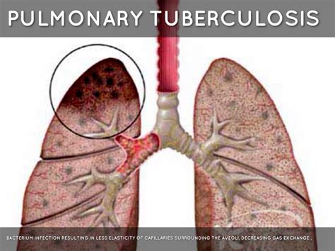 Tuberculosis Lungs Vs Healthy Lungs