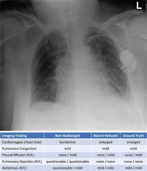 Ai Chest X Ray Algorithm Shows Promise For Emergency Department Reads