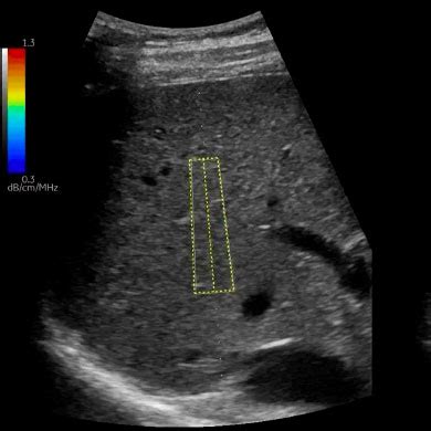 Liver Fibrosis Staging – Glenquarie Radiology