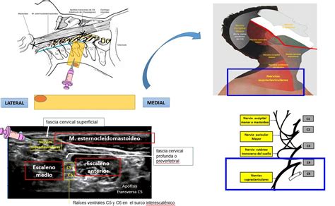 Bloqueo Del Nervio Supraclavicular Dolopedia Hot Sex Picture