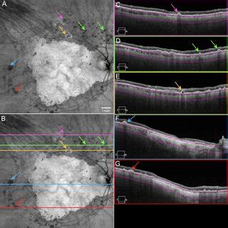 Octa Imaging Of Cnv In Patient Ga Ss Octa En Face And B Scan Imaging