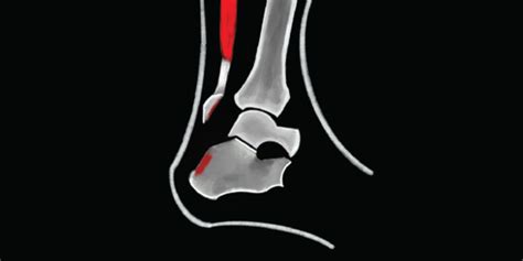 RACGP - The Achilles tendon