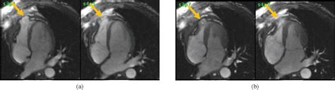 Figure From Constrictive Pericarditis Presenting With An Outpouching