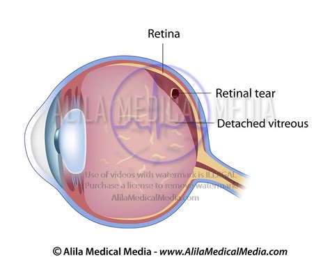 Alila Medical Media Retinal Tear Medical Illustration