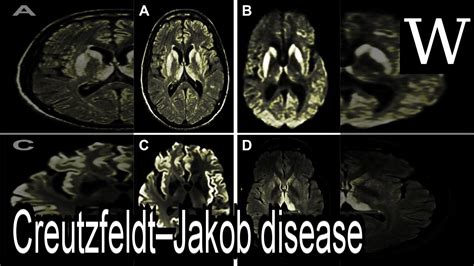 CreutzfeldtJakob Disease WikiVidi Documentary YouTube