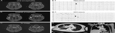 Gaba B Receptor Encephalitis Triggered By Enterovirus Enceph The Neurologist