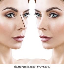 Woman Before After Cosmetic Nose Surgery Stock Photo 699963340 ...