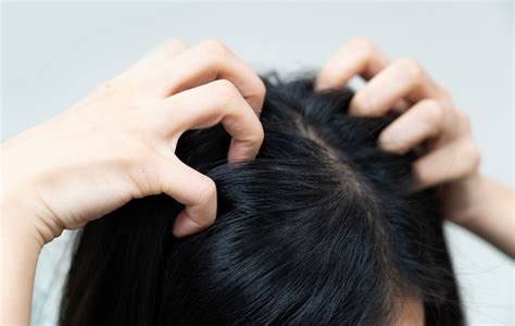 Dry Scalp Symptoms Causes Diet And Treatment Divi