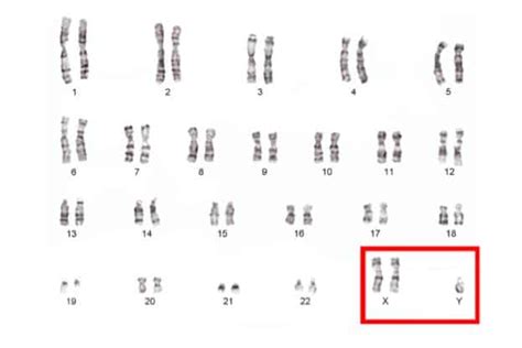 One In 500 Men Carry An Extra Sex Chromosome Raising Their Risk For Several Common Diseases