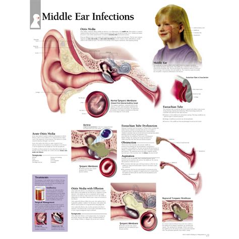 Ear Infection Diagram - exatin.info