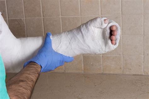 Orthopedic Technician Putting On A Fiberglass Plaster Cast Stock Image