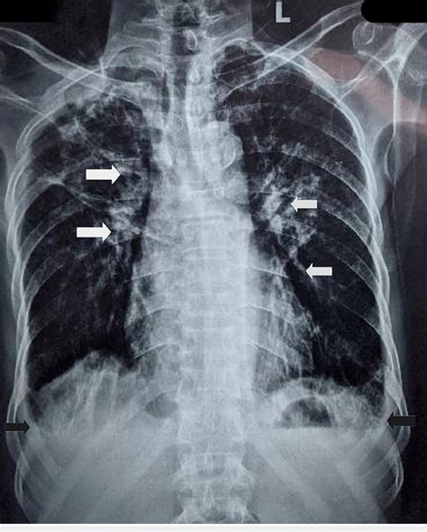 Chest X Ray Pa View Few Patchy Areas Of Ground Glass Opacities In Bl Download Scientific