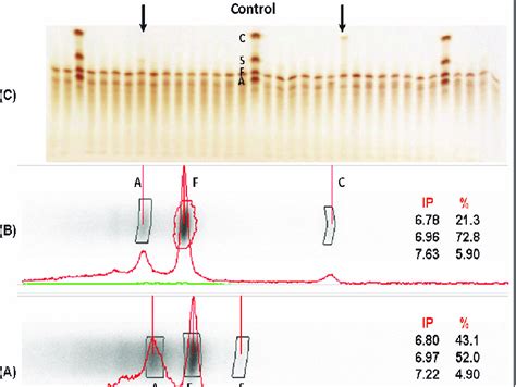 Densitometric Analysis Of Two Positive Cases One For Hb As A And One Download Scientific