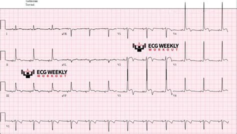 Do these biphasic T waves and ST segment abnormalities suggest acute ...