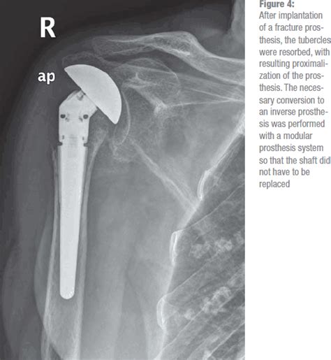 The Treatment of Proximal Humeral Fracture in Adults (02.09.2013)