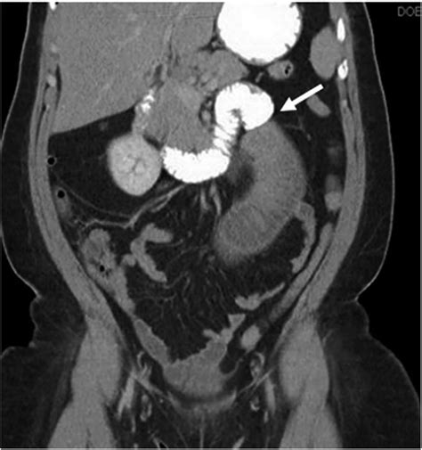 Adult Jejunojejunal Intussusception In The Face Of Jejunal Adenocarcinoma Two Infrequently