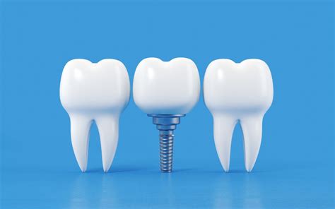 Advantage Of Implants Over Other Tooth Restoration Methods