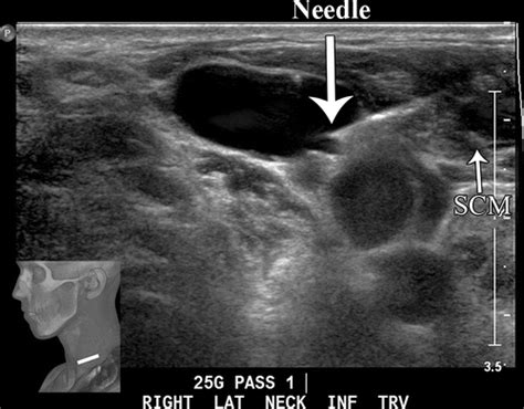 Us Guided Biopsy Of Neck Lesions The Head And Neck Neuroradiologist’s Perspective Radiographics