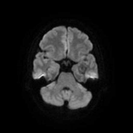 Cavernoma | Image | Radiopaedia.org