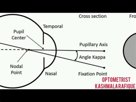 What Is Angle Kappa Part 2 How To Measure Positive And Negative