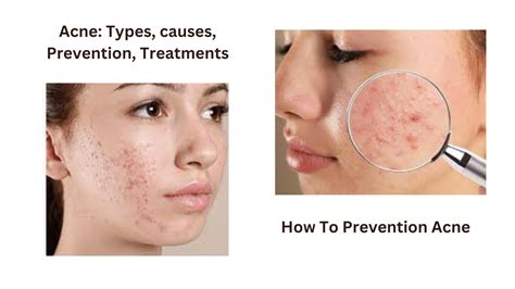 Acne Types Causes Prevention Treatments Medical Health Guide Best Treatments 2023