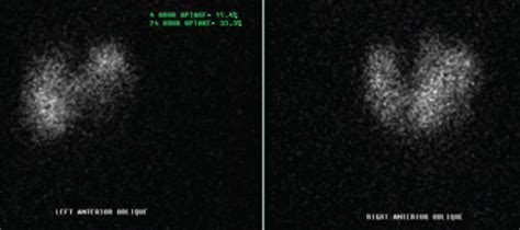 Thyroid Uptake I 123 Scintigraphy Showing Elevated Radioactive Iodine