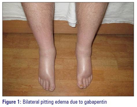 Bilateral Peripheral Edema