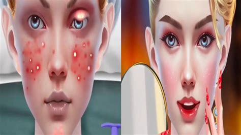 Acne And Pimple Removal Treatment Acne Deep Cleaning Animation Cool