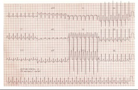 Clin Med Arrhythmia Management Flashcards Quizlet