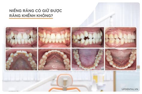 Th C M C Ni Ng R Ng C Gi C R Ng Kh Nh Kh Ng Up Dental