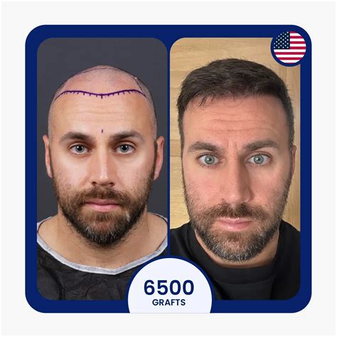 sapphire fue hair transplant  turkey vera clinic