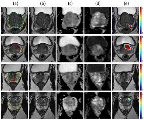 Deep Learningassisted Prostate Cancer Detection On Bi Parametric Mri