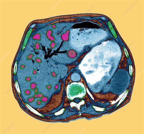 Liver cancer, CT scan - Stock Image - M175/0398 - Science Photo Library