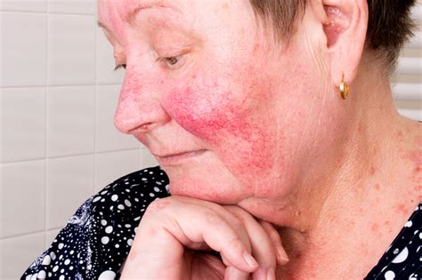 Signs And Symptoms Of Rosacea And Ways To Help Vibrance Medspa