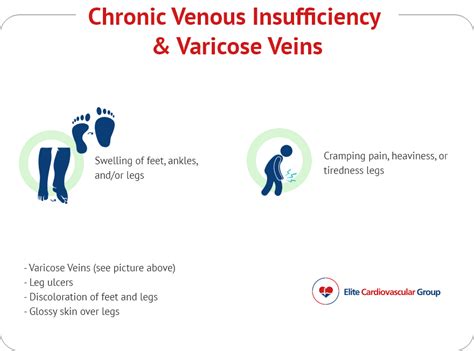 Chronic Venous Insufficiency And Varicose Veins Elite Cardiovascular Group