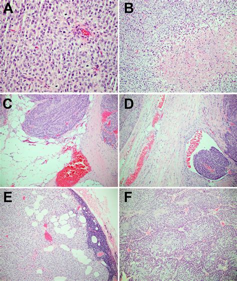 Histopathologic Features Of Adrenocortical Carcinomas Including High Download Scientific