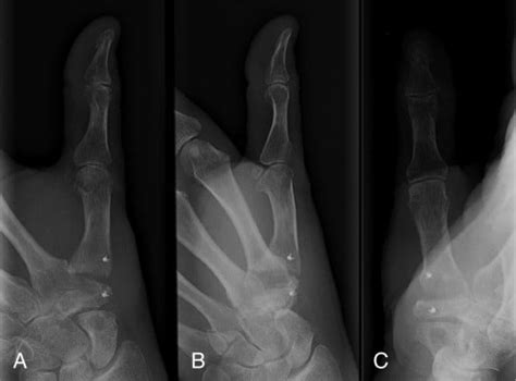 Optimal Management Of Thumb Basal Joint Arthritis Challenges And Solu